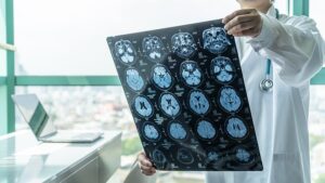 Concussion Symptoms 
