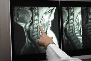 Receiving a Settlement After Suffering a Herniated Disk